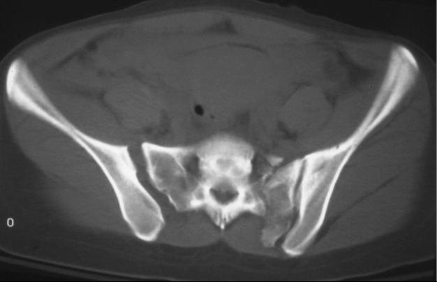 Pelvic Ring Fractures Trauma Orthobullets